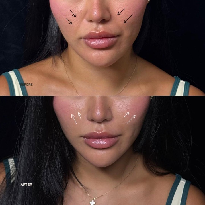 Dolphin —Skin Barrier Glider